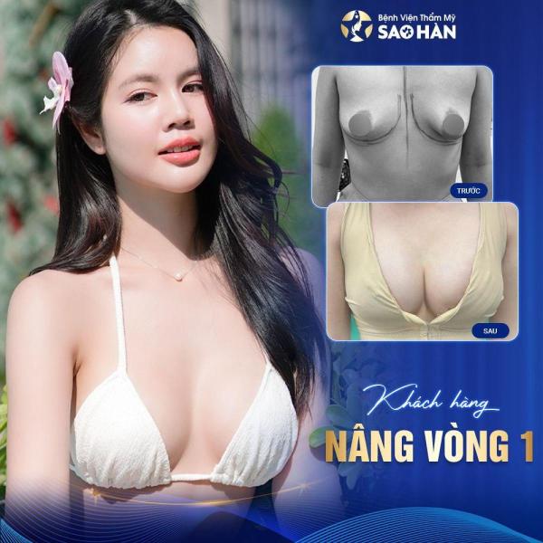 Chỉnh hình ngực xệ – Mức 3