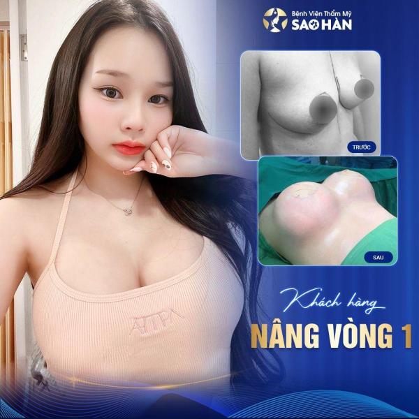 Chỉnh hình ngực xệ – Mức 2