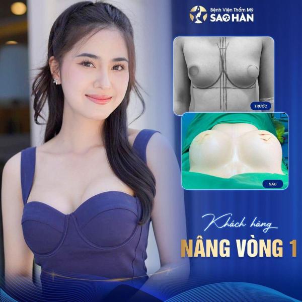 Chỉnh hình ngực xệ – Mức 1