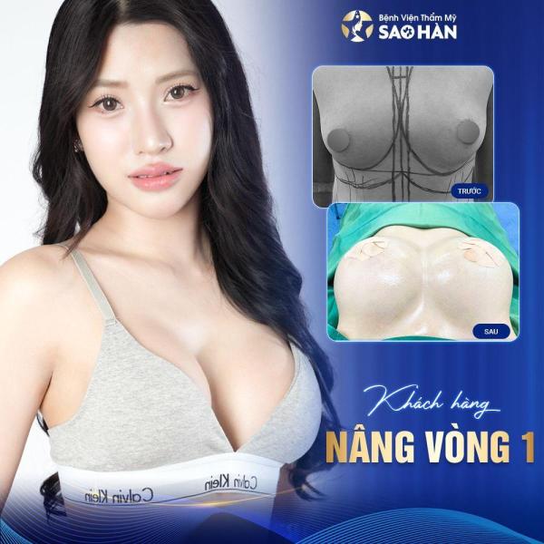 Phẫu thuật núm vú tụt