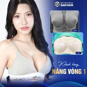 Phẫu thuật núm vú tụt