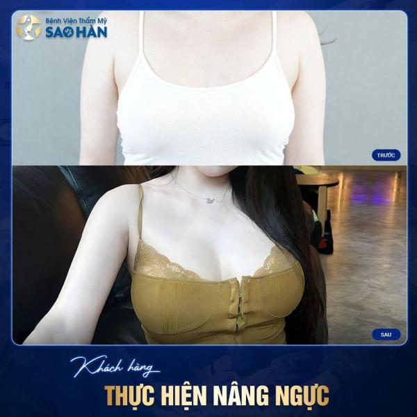 Thu gọn quầng vú