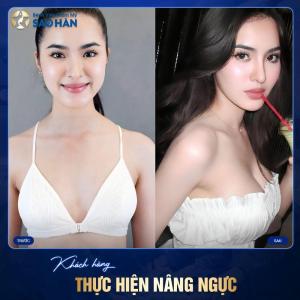Cắt tuyến vú phụ