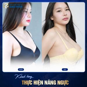 Thu gọn ngực phì đại