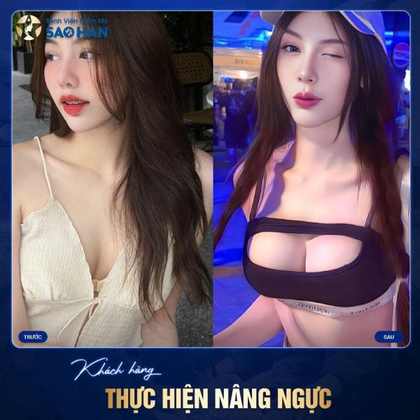 Cấy mỡ ngực (bổ sung trong lúc đặt túi)