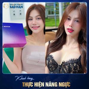 Nâng ngực - Túi Mentor trơn MemoryGel Xtra Vip