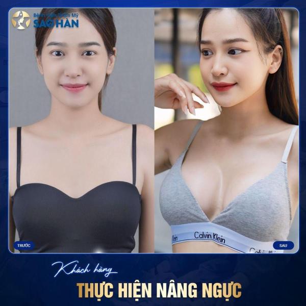 Nâng ngực  - Túi Mentor trơn tròn