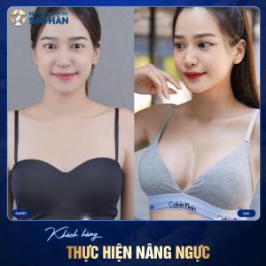 Nâng ngực  - Túi Mentor trơn tròn