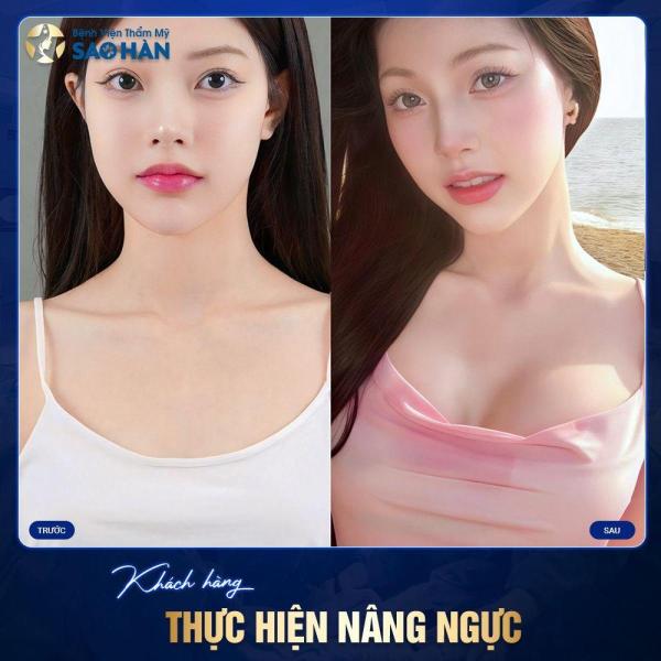 Nâng ngực  - Túi Mentor nhám tròn