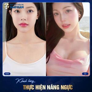 Nâng ngực  - Túi Mentor nhám tròn