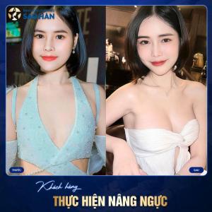 Nâng ngực túi Nano Chip Ergonomix