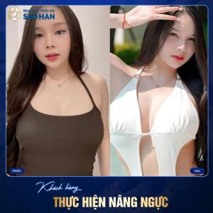 Nâng ngực túi Nano không Chip