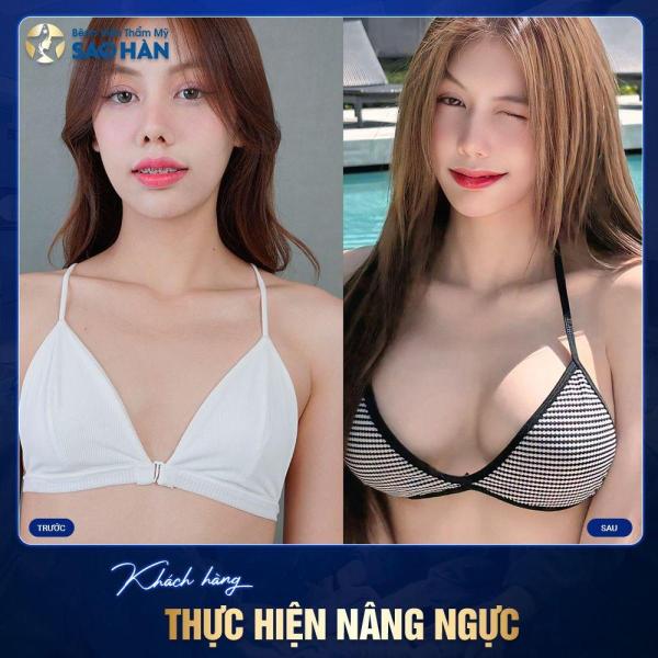 Nâng ngực túi Đức Polytech