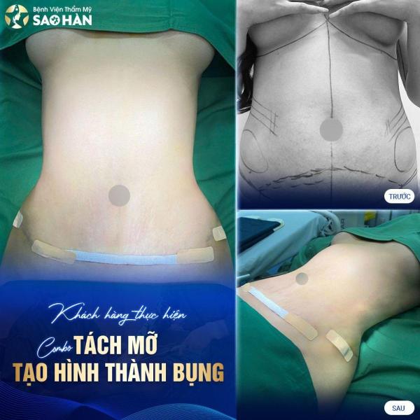 Hút mỡ bụng Ultra Smart Mới