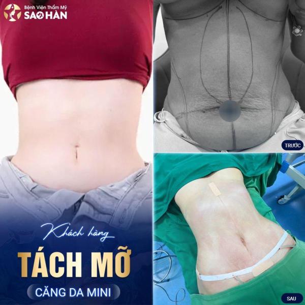 Hút mỡ + tái tạo thành bụng bán phần - 3/3
