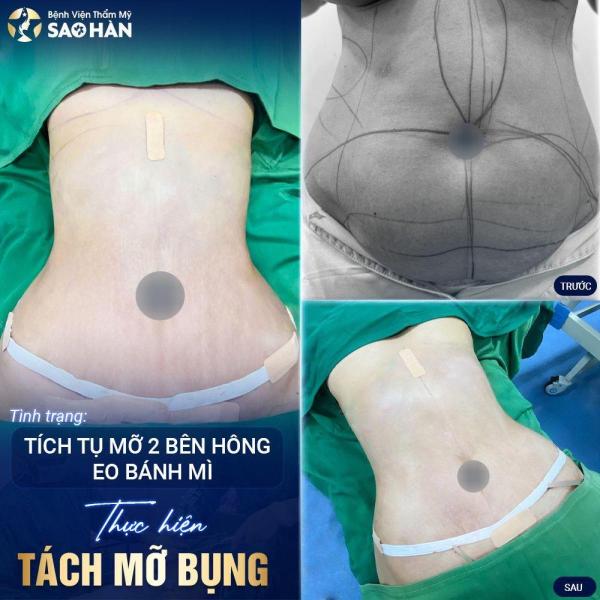 Hút mỡ + Tái tạo thành bụng toàn phần - 1/3