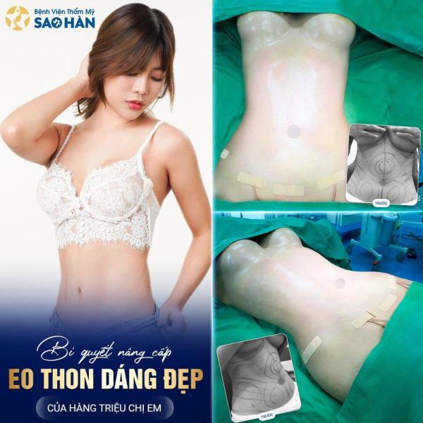 Hút mỡ eo