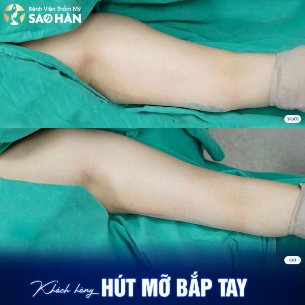 Hút mỡ cánh tay, nách - 1/3