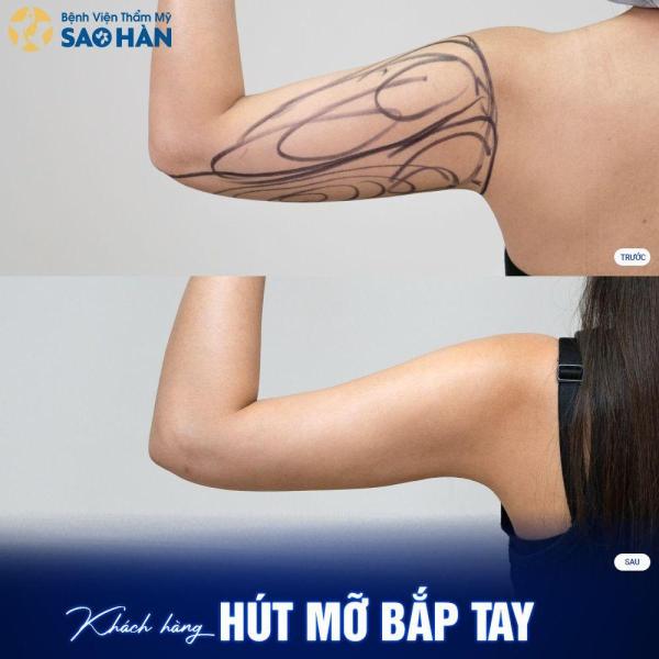Hút mỡ cánh tay, nách - 2/3