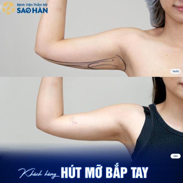 Hút mỡ cánh tay, nách - 3/3