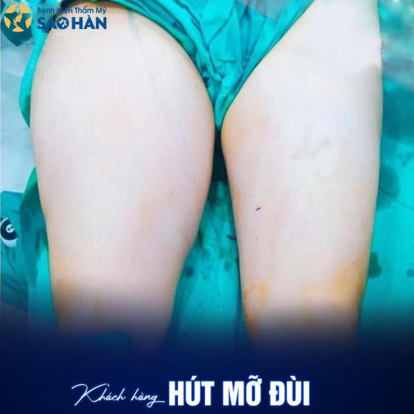 Hút mỡ Vùng mông, rãnh mông đùi, vùng đùi, háng - 1/3