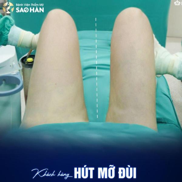 Hút mỡ Vùng mông, rãnh mông đùi, vùng đùi, háng - 2/3