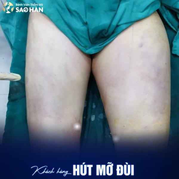 Hút mỡ Vùng mông, rãnh mông đùi, vùng đùi, háng - 3/3