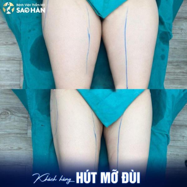 Hút mỡ đùi - 1/3