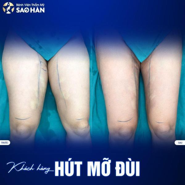 Hút mỡ đùi - 2/3