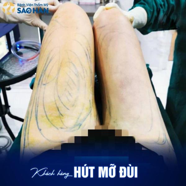 Hút mỡ đùi - 3/3