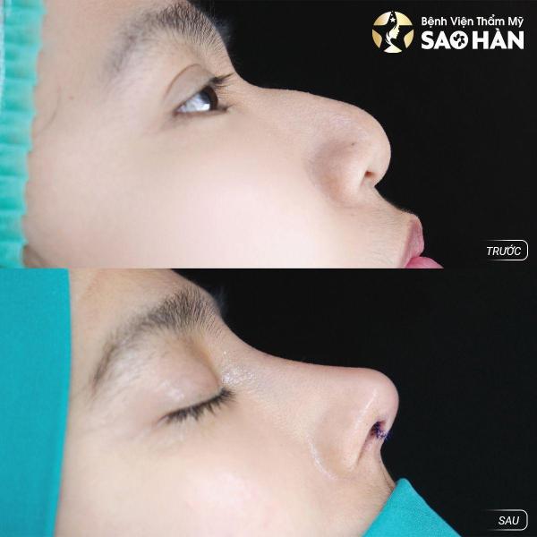Nâng Mũi Perfect Sụn Sườn Tự Thân - 1/3