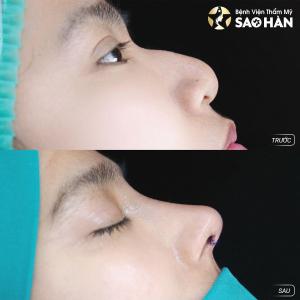 Nâng Mũi Perfect Sụn Sườn Tự Thân