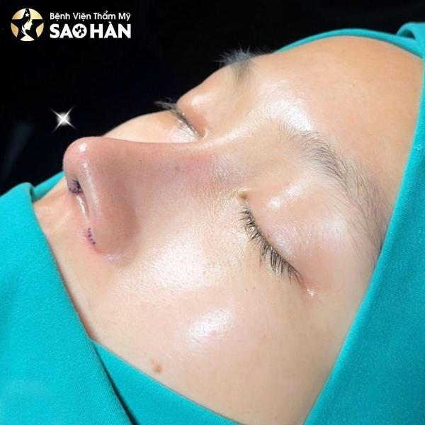 Nâng Mũi Perfect Sụn Sườn Tự Thân - 2/3