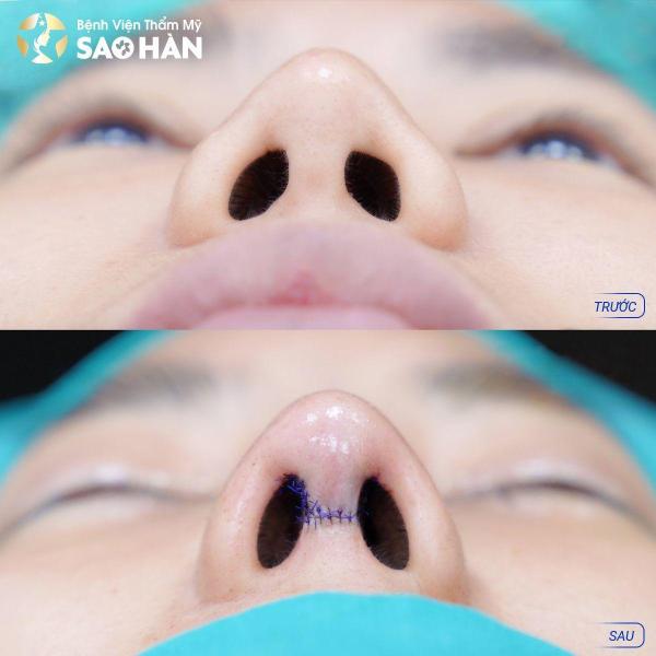 Nâng Mũi Perfect Sụn Sườn Tự Thân - 3/3