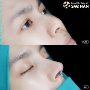 Nâng Mũi Perfect + Dựng Vách Ngăn 5D