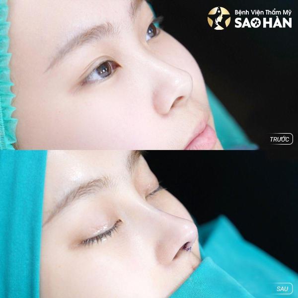 Nâng Mũi Perfect + Dựng Vách Ngăn 5D - 2/3
