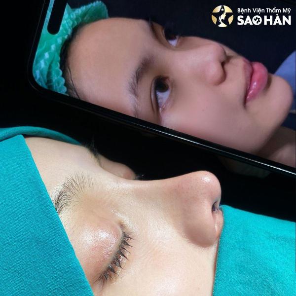 Nâng Mũi Perfect + Dựng Vách Ngăn 5D - 3/3