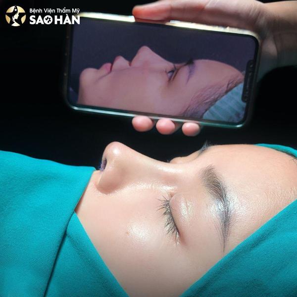 Nâng Mũi Cấu Trúc Perfect "Mới"