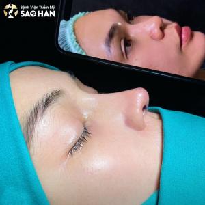 Nâng Mũi Cấu Trúc Perfect + Đục Xương Cánh Mũi