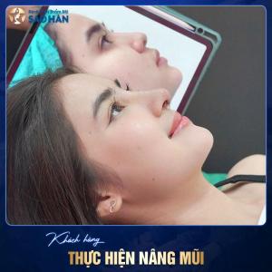 Nâng Mũi S-Line – 3D PT