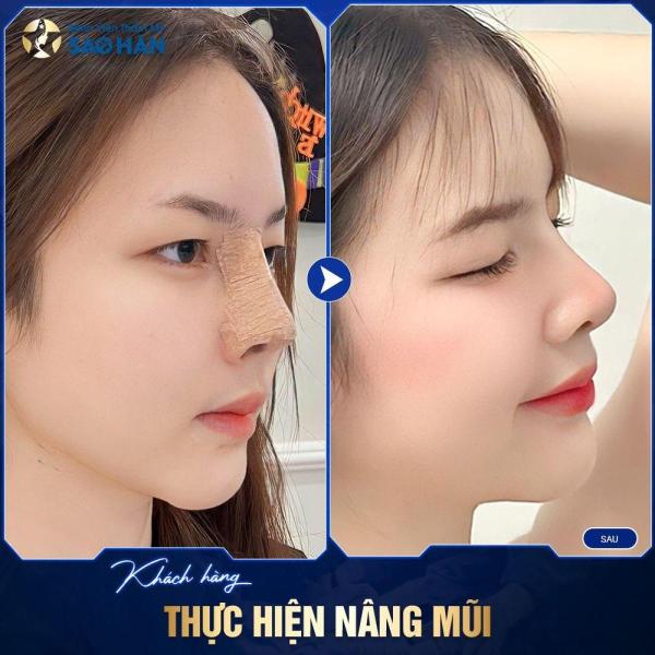 Nâng mũi Perfect + đục xương cánh mũi – Mũi khó