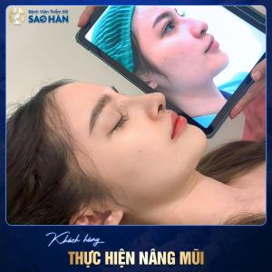 Mũi S-Line sụn sườn tự thân Tái Phẫu Thuật – Mũi khó