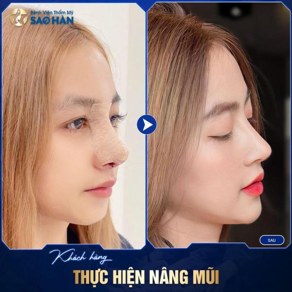 Mũi S-Line Sụn Sườn Tái Phẫu Thuật