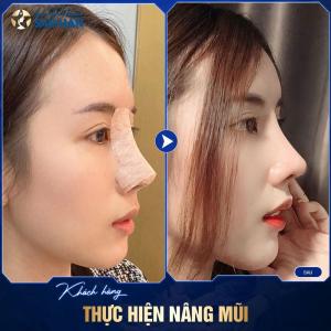 Nâng Mũi S-Line Tái Phẫu Thuật (Mức 4)