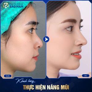 Nâng Mũi S-Line Tái Phẫu Thuật (Mức 3)