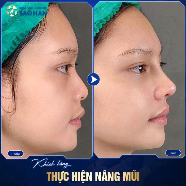 Nâng Mũi S-Line Tái Phẫu Thuật (Mức 1)