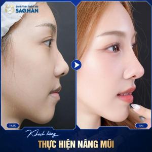 Nâng Mũi S-Line Tái Phẫu Thuật (Mức 2)