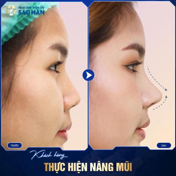 Nâng Mũi S-Line Tái Phẫu Thuật (Mức 2) - 3/3