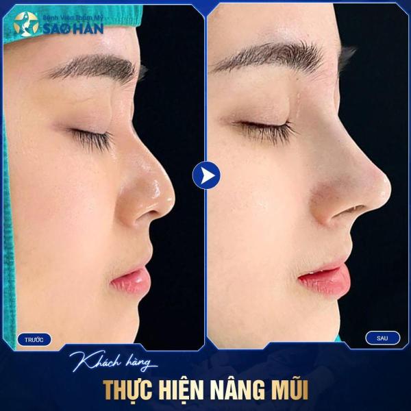 Nâng mũi cấu trúc S-Line Surgiform
