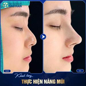 Nâng mũi cấu trúc S-Line Surgiform